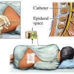 Giving an Epidural Anaesthetic