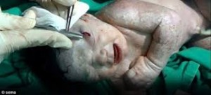 Baby born with schrapnel wound